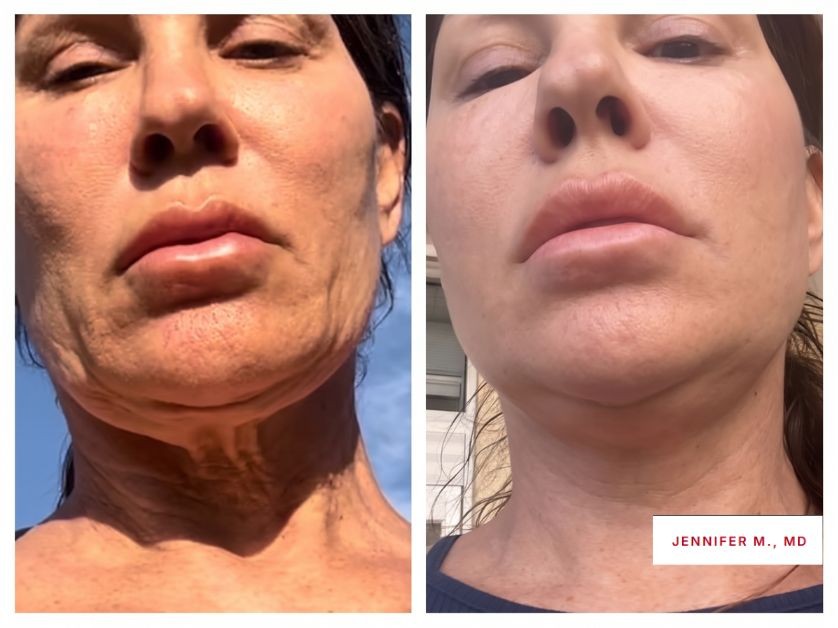 Skin sagging after injections