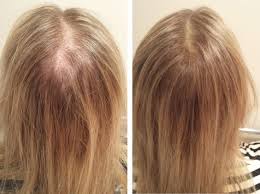 Rebound effect after stopping Ozempic